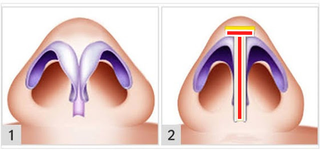 Drooping Nose Tip Surgery - Nose Tip Plasty in Istanbul - Nasal Tip Plasty in İstanbul - Nose Tip Reshaping in İstanbul - Nose Tip Surgery in İstanbul - Nose Tip Lifting in İstanbul - Droopy Nasal Tip Rhinoplasty - Droopy Nasal Tip Correction - Droopy Nasal Tip Surgery - Nasal Tip Ptosis - Droopy Tip Correction - Nose Tip Surgery Turkey