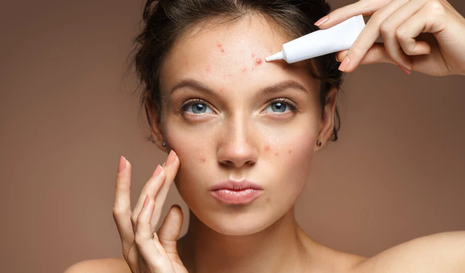 Como se Livrar Rápido de Acne (Espinhas)