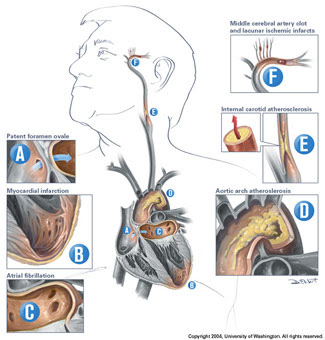 Prevent Stroke