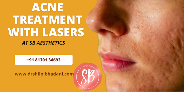 acne scar laser treatment in Gurgaon