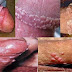 Seperti Kutil Di Anus thumbnail