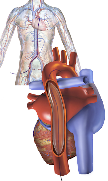 主動脈內氣球幫浦 Intra-aortic balloon pump, IABP