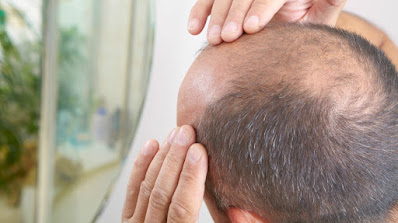 baldness homeremedies