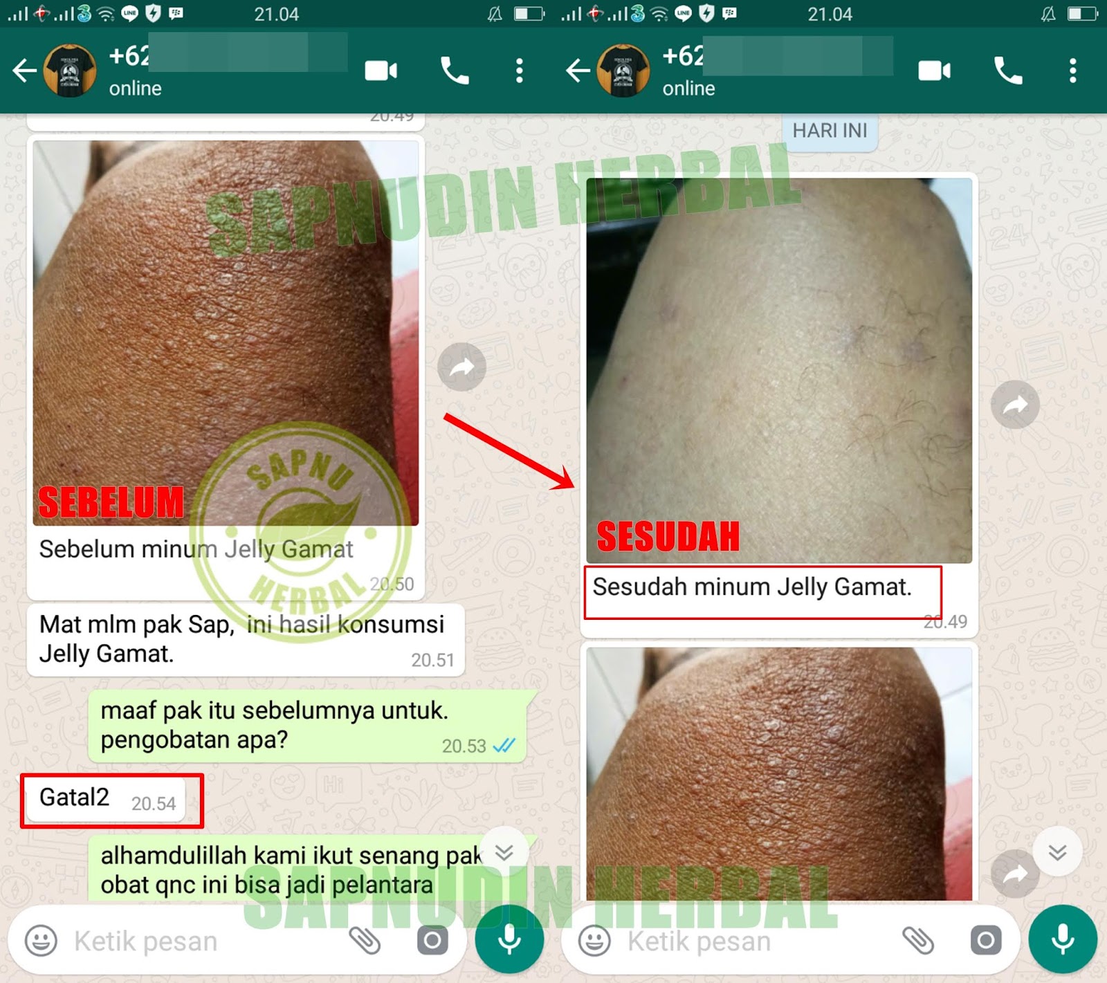 Cara Mengobati Kaligata Pada Ibu Hamil Yang Aman Dan ...