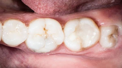 Trả lời nhổ răng cấm hàm dưới có ảnh hưởng gì không-1