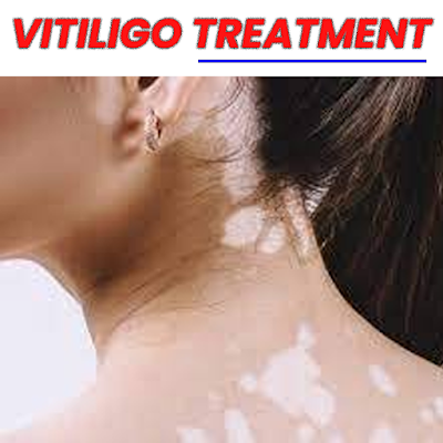 vitiligo treatment by homeopathy