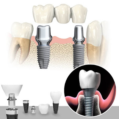 Ưu điểm của phương pháp cấy ghép implant