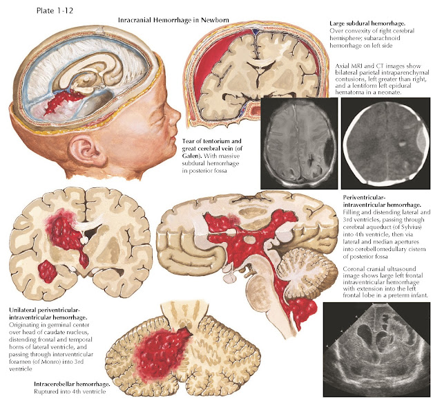 INTRACRANIAL HEMORRHAGE IN THE NEWBORN