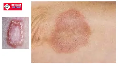 What Is Granuloma Annulare(GA)?