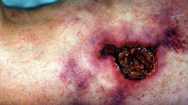 Calciphylaxis