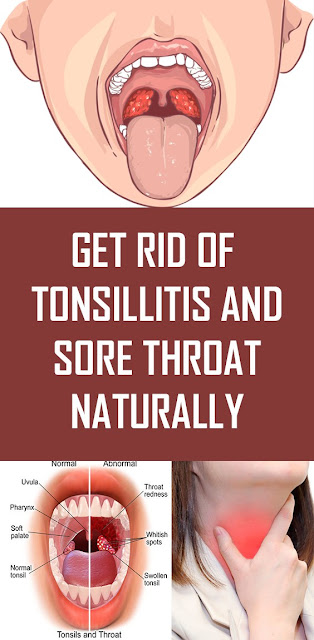 Get Rid Of Tonsillitis & Sore Throat Naturally