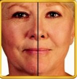 face lift without surgery