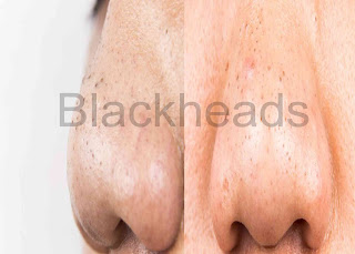 Proper Ingredients that Remedies Your Blackheads