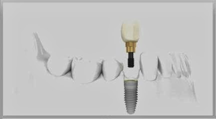 Dental Implants