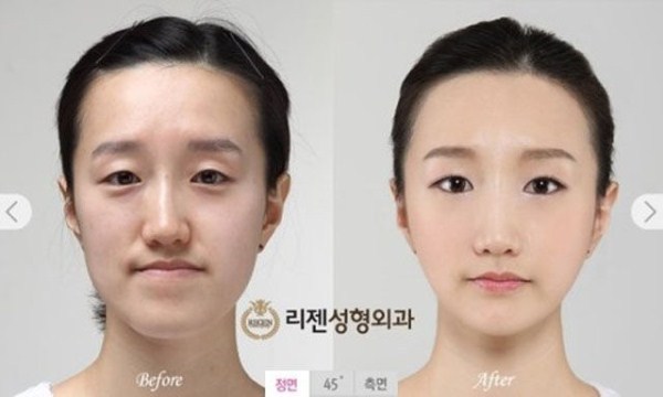 韓国人の整形前と整形後の写真が話題に エイリアンみたいという声も 韓国では顎ラインを細く 西洋ではシッカリが人気の基準 海外の反応