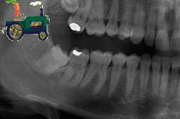 <Img src ="tercer-molar-empujando-dientes.Gif " width = "400" height "265" border = "0" alt = "Radiografía que muestra un tractor y la muela del juicio.">