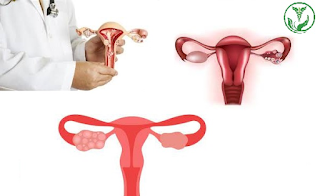 متلازمة تكيس المبايض,تكيس المبايض,تكيس المبايض والحمل,تكيس المبايض عند البنات,