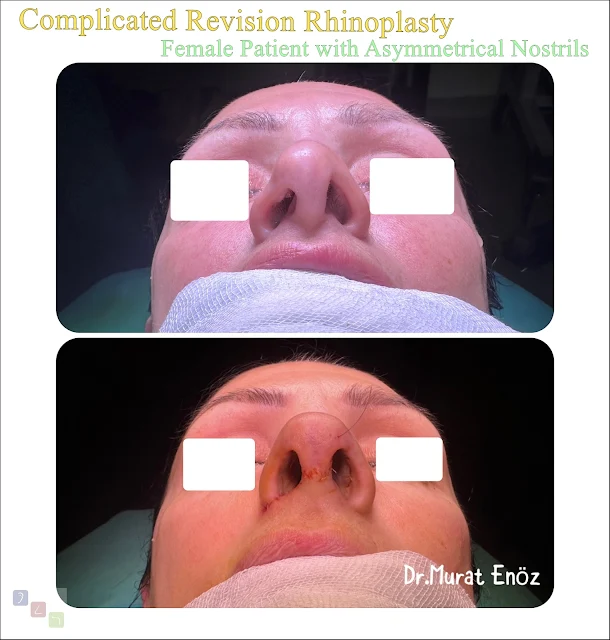complicated revision rhinoplasty, female rhinoplasty, asymmetrical nostrils correction, complex rhinoplasty surgery, revision rhinoplasty specialist, open revision rhinoplasty, cartilage grafting in rhinoplasty, nasal valve collapse, nasal tip revision surgery, functional rhinoplasty, nasal airway obstruction, scar tissue rhinoplasty, septoplasty revision, auricular cartilage graft, costal cartilage graft, nostril asymmetry correction, refined nasal tip revision, natural rhinoplasty results, rhinoplasty aftercare tips, experienced rhinoplasty surgeon, facial aesthetic harmony, nasal reconstruction surgery, revision nose job, difficult rhinoplasty case, feminine nasal symmetry, secondary rhinoplasty procedure