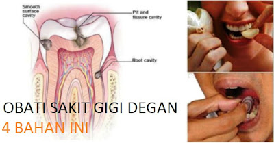 Cara Menuntaskan Sakit Gigi Sampai Keakar-akarnya