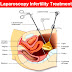 WHAT IS LAPAROSCOPY? A BRIEF EXPLANATION: DR RAMA SOFAT HOSPITAL