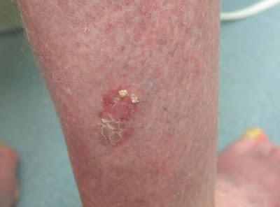 Bowen's Disease Pictures1