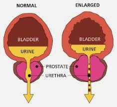http://metropolehospital.com/andrologi/sakit-prostat