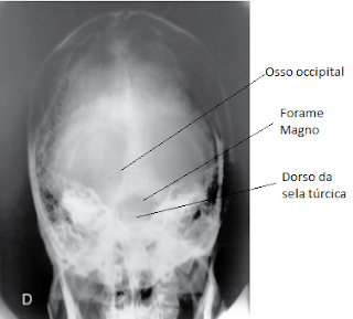 rx cranio