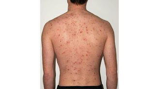 Chicken pox Pharmacotherapy