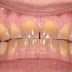 Nguyên nhân khiến răng ố vàng từ bên trong