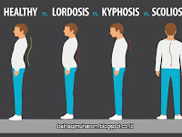 Apa Itu Kelainan Tulang Kifosis Skiliosis dan Lordosis ?