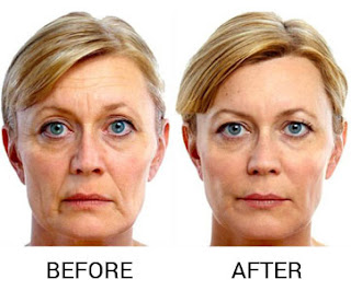 Botox Treatment in Delhi