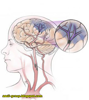 أربع مسببات للسكتة الدماغية عند الرجال Stroke in men