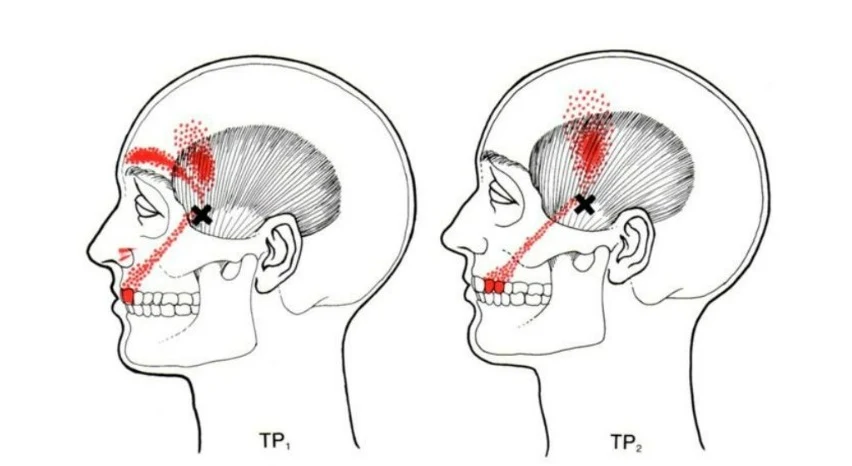 dolor cervical y dolor de cabeza - temporal tp1 y tp2 - mc spa