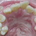 Quy trình bọc răng sứ cho răng khấp khểnh nhẹ