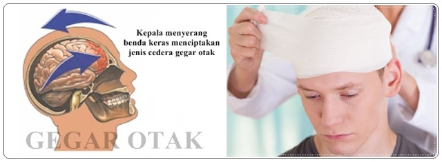 gegar-otak-obat-herbal-alami-enbepe