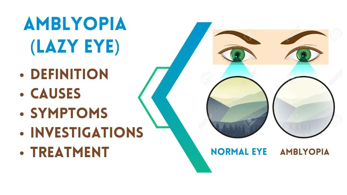 Amblyopia (Lazy Eye)