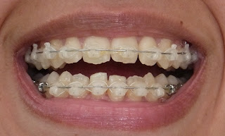 damon braces, damon clear braces, progress picture, photo, clear brackets, wires