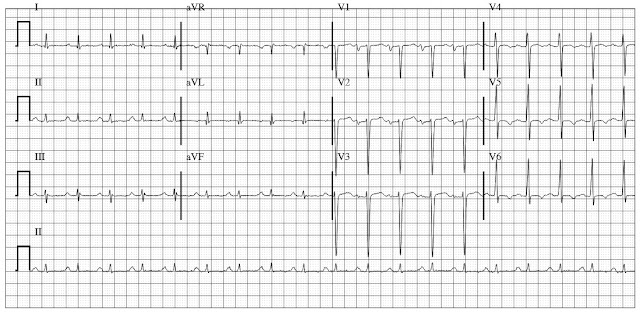 ECG of dilated cardiomyopathy