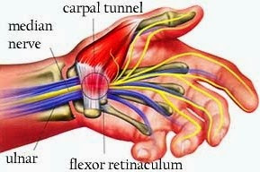 Carpal Tunnel Syndrome