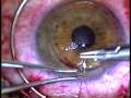 http://pathologyvideos.blogspot.ro/2014/04/corneal-transplant.html