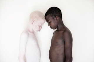 Askep pada Pasien dengan Albinisme (Albino)