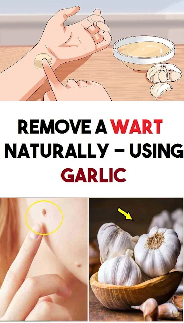 Natural Ways to Get Rid of Warts Using Garlic