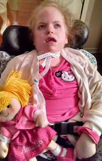  A girl suffering from the devastating effect of Sanfilippo syndrome pictures