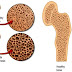 Osteoporosis: Symptoms, Causes, Prevention, and Treatment.