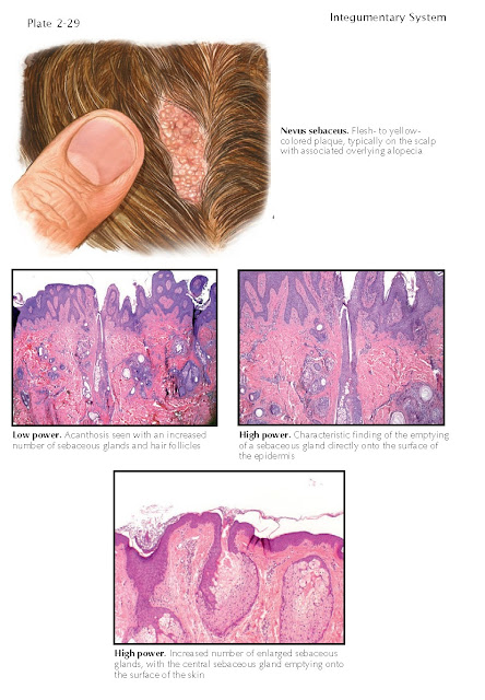 Nevus Sebaceus