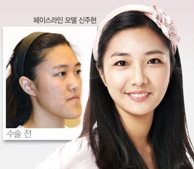 Korea Surgery ~ Kome Yang Suke Sangat Korea