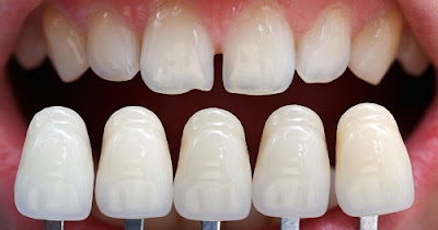 Làm răng sứ có hại không?
