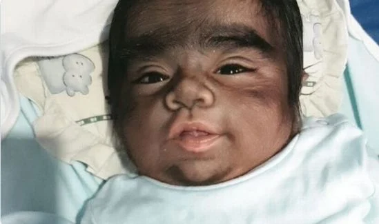 Drug Threatens Infants with a Serious Syndrome