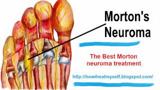 TOP Morton neuroma treatment