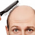Hair Loss preventions and treatments.
